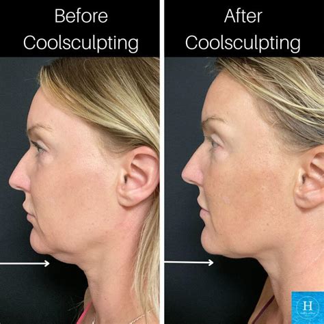 Know If CoolSculpting Is For You .